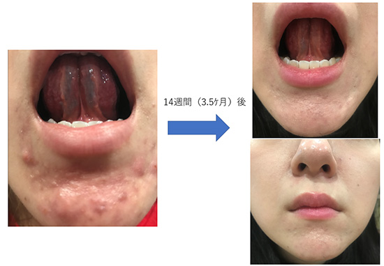 中学生の頃から悩んでいたニキビ 体験談 漢方薬局 美遥